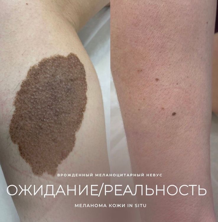 Меланома in situ
