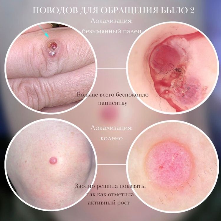 Добро и зло на коже у 1 пациента 