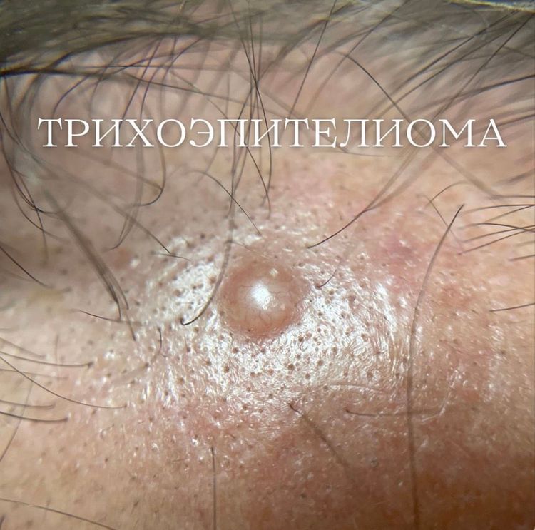 Трихоэпителиома