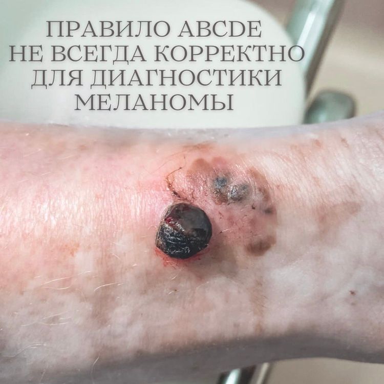 Правило ABCDE работает не всегда 