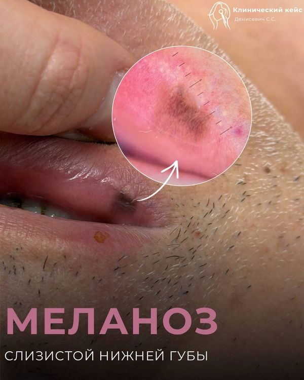 Меланоз слизистых оболочек