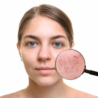 Логотип Телеграм канала АКНЕБЛОГ. Бесплатная аналитика Telegram каналов