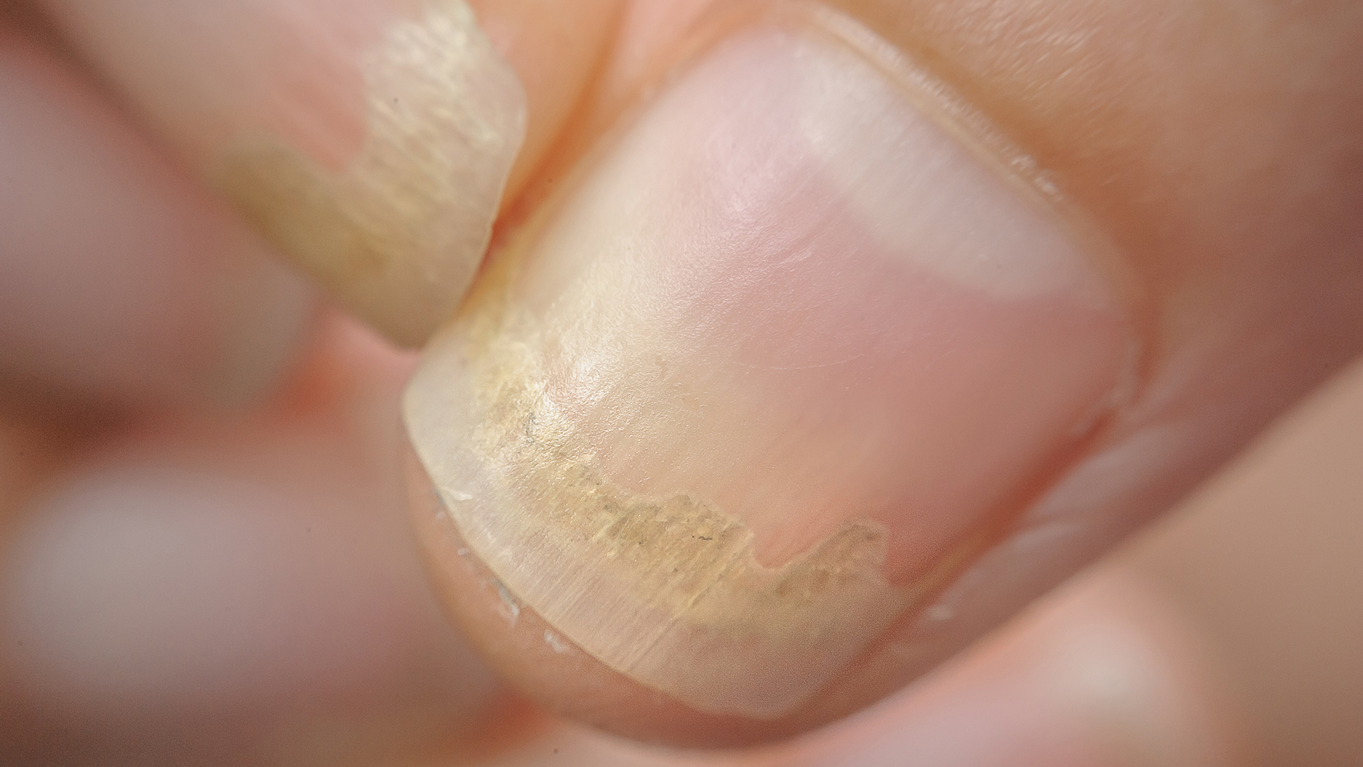 Обработка ногтей при грибковом поражении (онихомикозе)