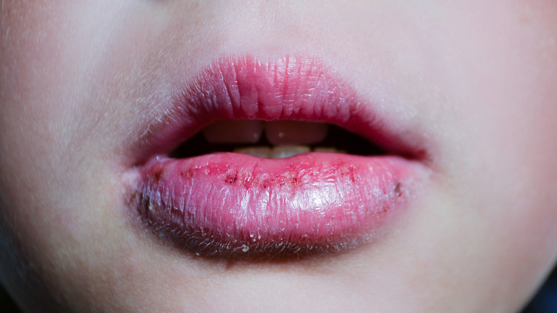 Как быстро вылечить вирус на губах: общие рекомендации