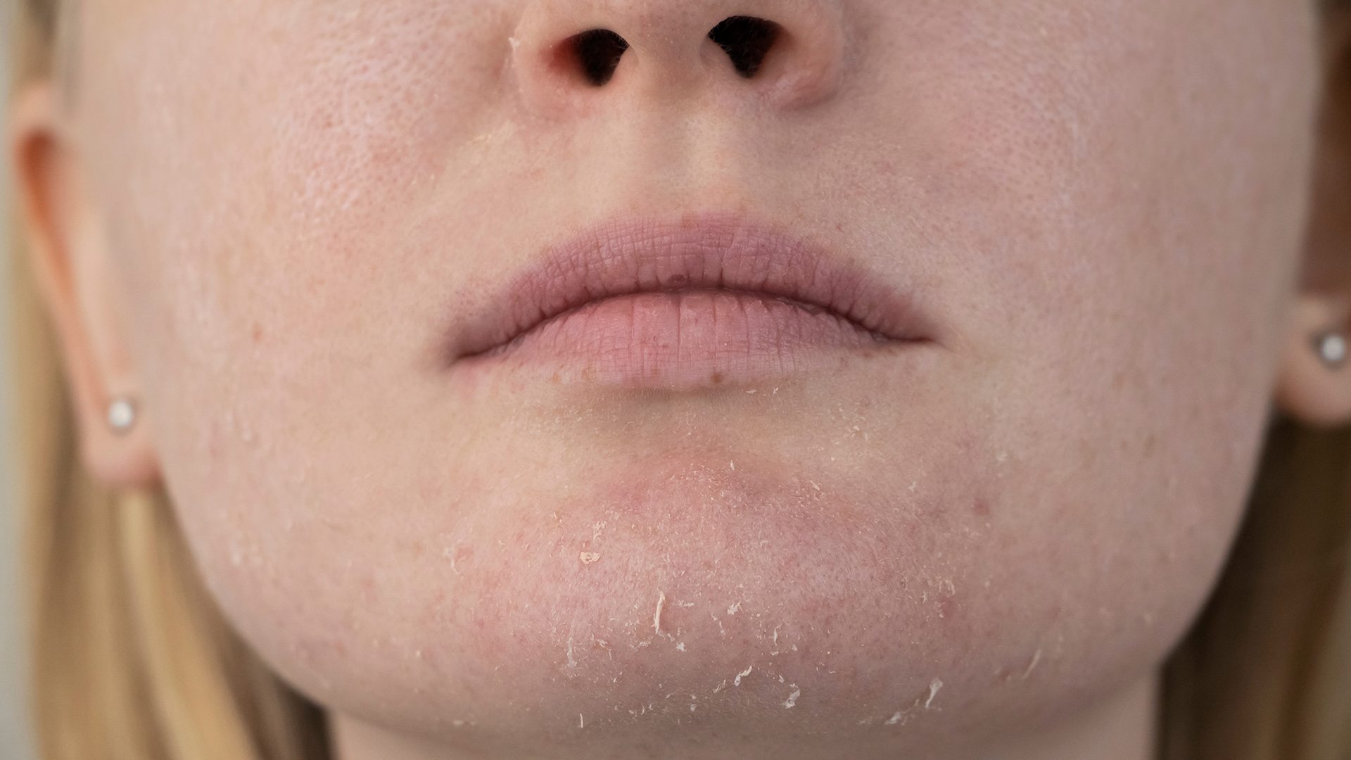 Особенности сухой кожи лица