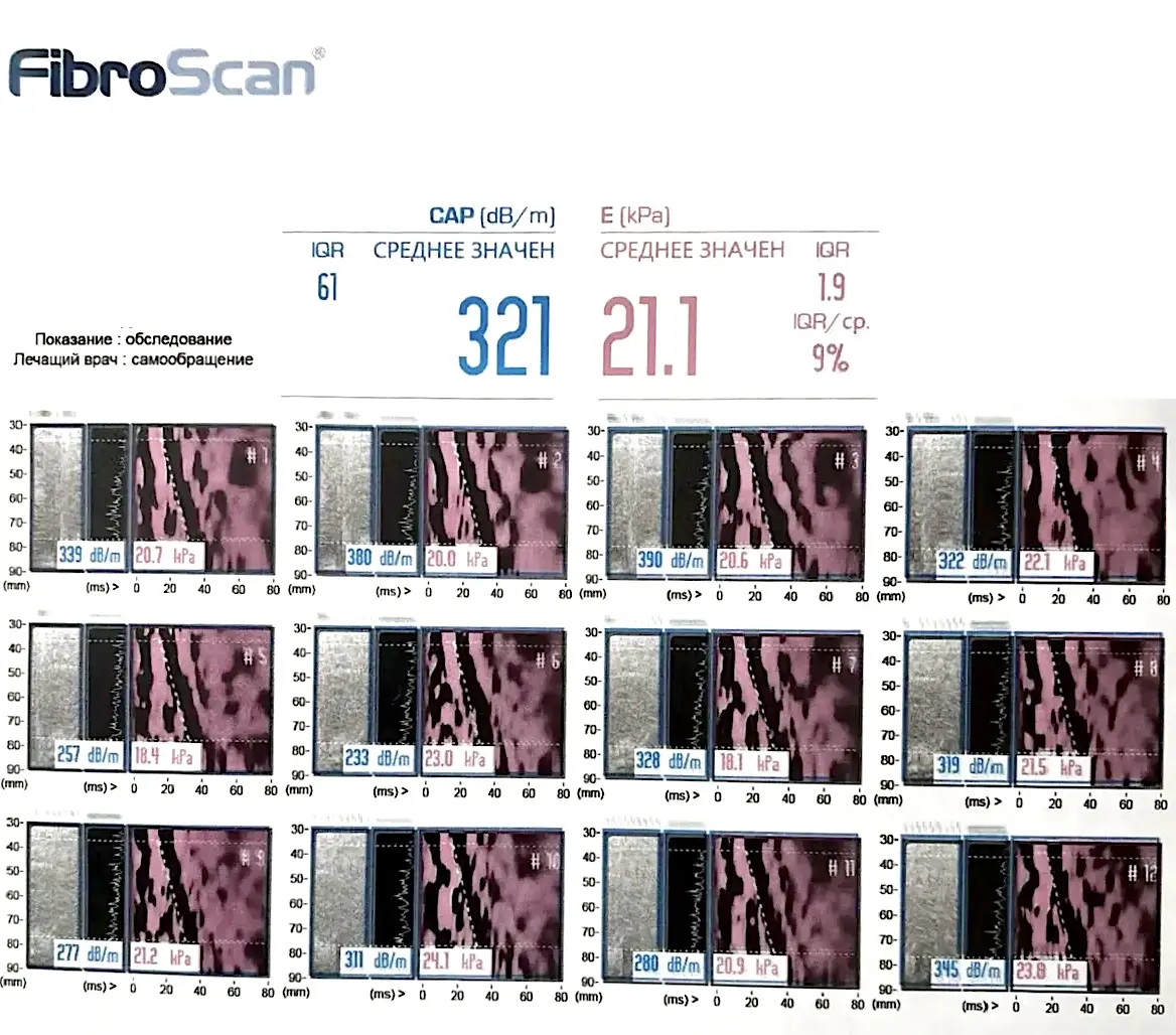 Пример результатов обследования печени методом эластографии