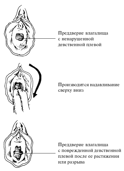 Узкое влагалище - причины, что делать