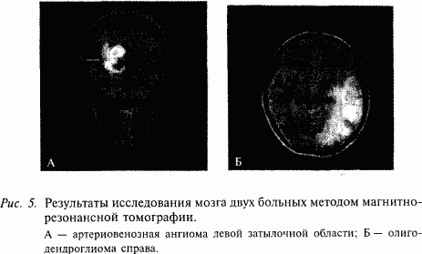 Мр картина единичных очагов в белом веществе головного мозга вероятно сосудистого генеза