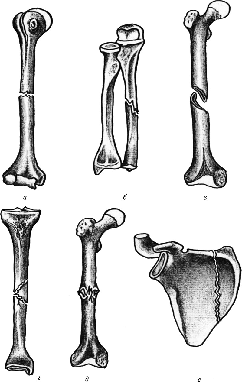 Переломы трубчатых костей