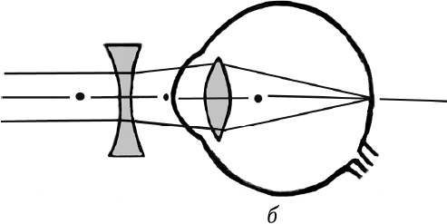 На рисунке 10 приведены схемы хода лучей в глазе при близорукости