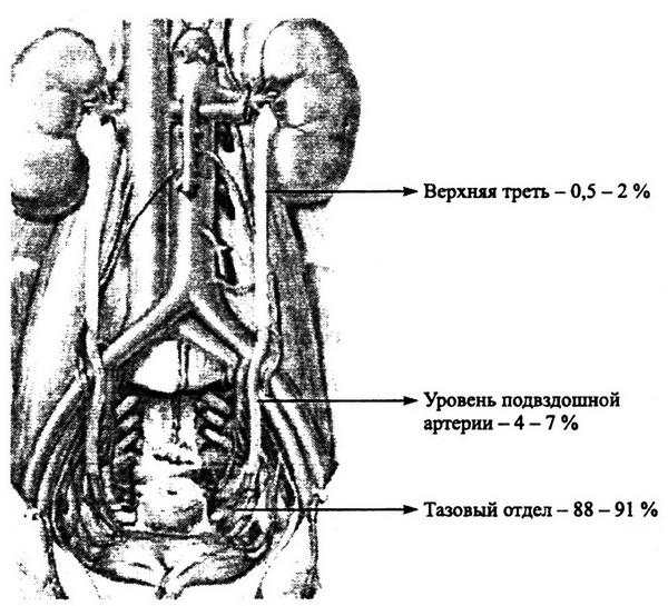 Нижняя треть мочеточника. Камень в нижней трети мочеточника. Верхняя средняя и нижняя треть мочеточника. Топографическая анатомия тазового отдела мочеточников. Камень в средней трети мочеточника это где.