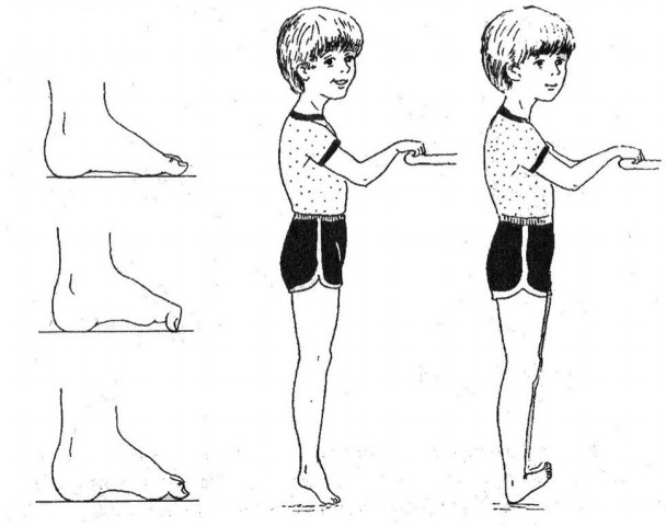 Лечебная гимнастика при плоскостопии с картинками