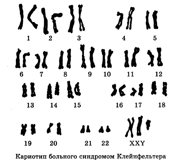 Изображение кариотипа человека. Кариотип человека с синдромом Марфана. Синдром Марфана хромосомы. Синдром Марфана кариотип. Кариотип больного с синдромом Эдвардса.