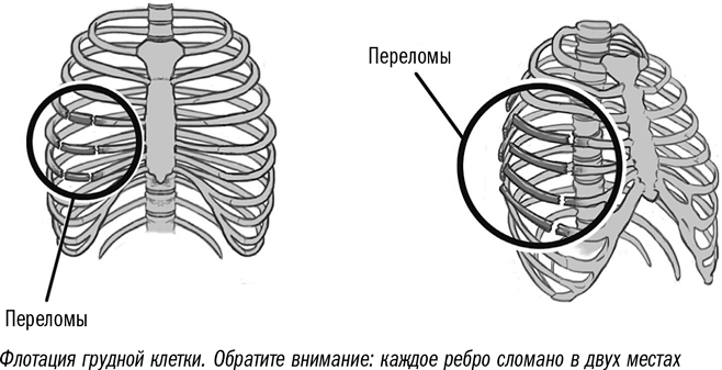 Как лечить ребра