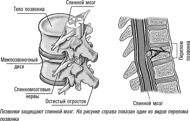 Перелом позвоночника рисунок