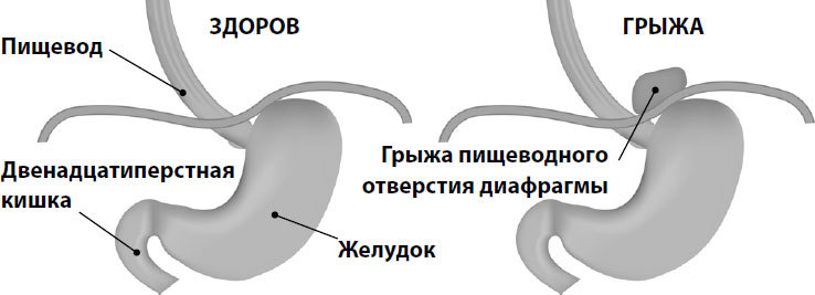 Каша при диафрагмальной грыже