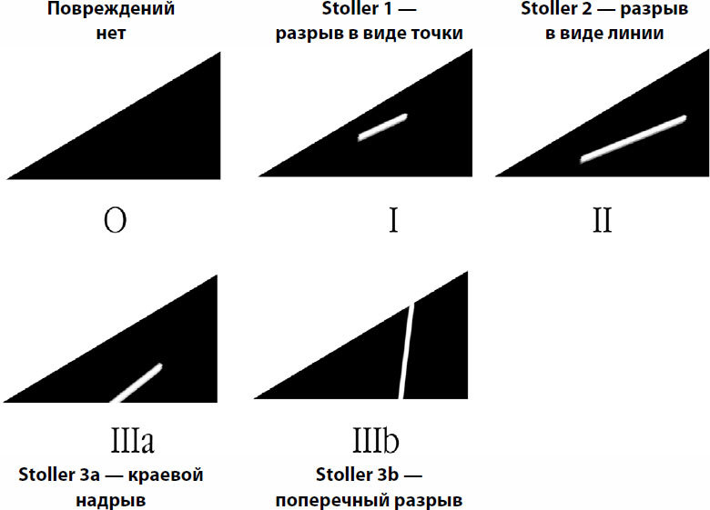 Мр картина повреждения внутреннего мениска 3а степени по stoller