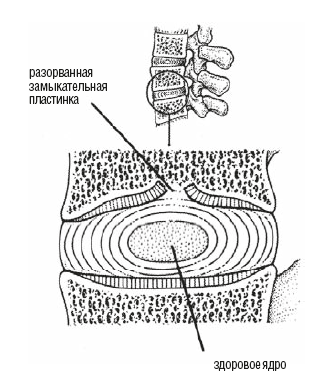 Склероз замыкательных пластинок. Замыкательная пластина позвонка. Замыкательная пластинка межпозвоночного диска. Анатомия позвонка замыкательная пластинка. Замыкательные пластинки тел позвонков уплотнены.