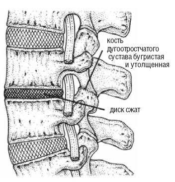 Дугоотросчатые суставы шейного отдела