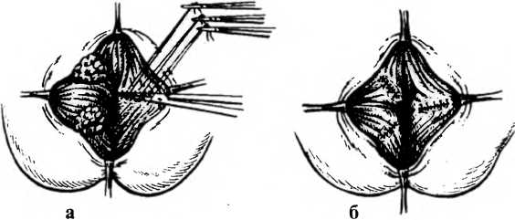 Геморроидопексия операция лонго. Латексное лигирование внутренних геморроидальных узлов. Заживление ран после операции геморроя. Инфракрасная фотокоагуляция хронической анальной трещины. Заживление ран после операции геморроя.